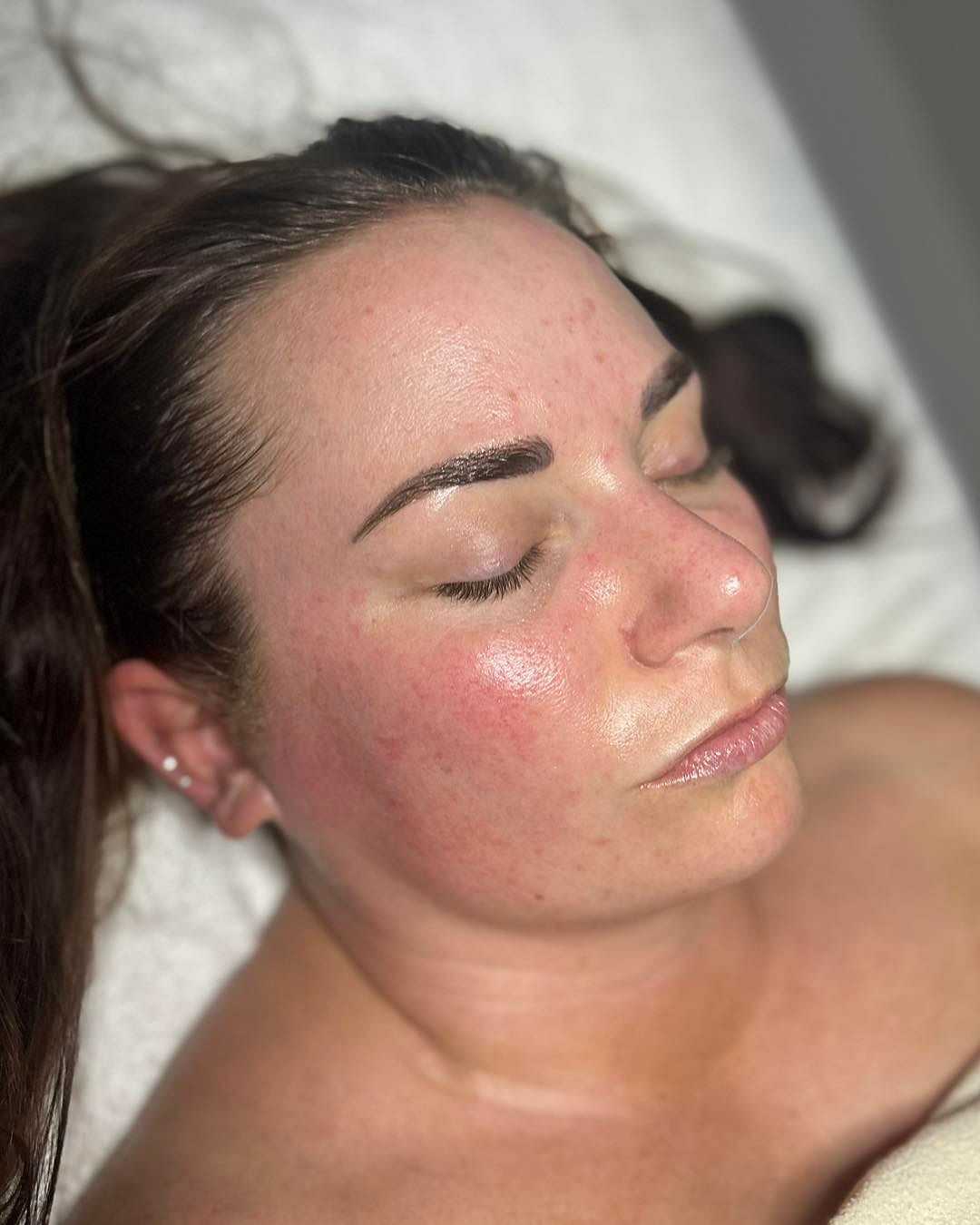 Woman with facial redness and closed eyes, lying down on a white surface, possibly during skincare.