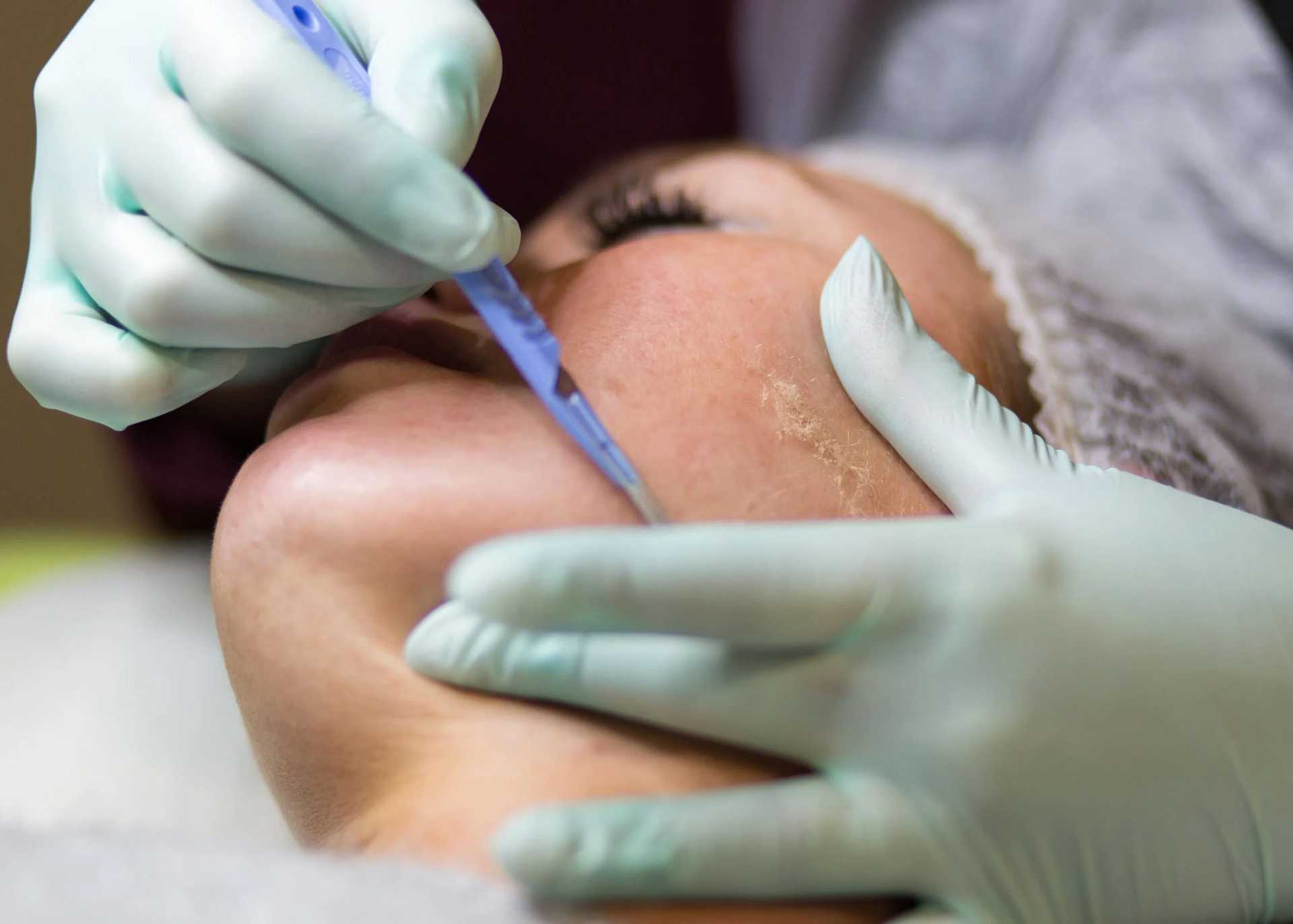 Close-up of a cosmetologist performing dermaplaning on a woman's face.